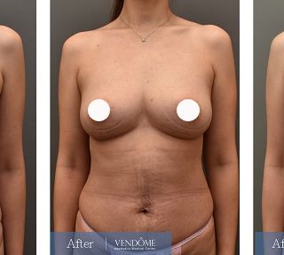 療程效果因人而異，上圖為D罩杯卻乳房下垂的女性在做完自體脂肪隆乳之後​手術後一個月、手術後八個月成效